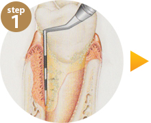 step1