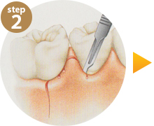 step2