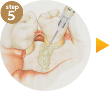 step5
