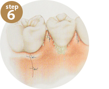 step6